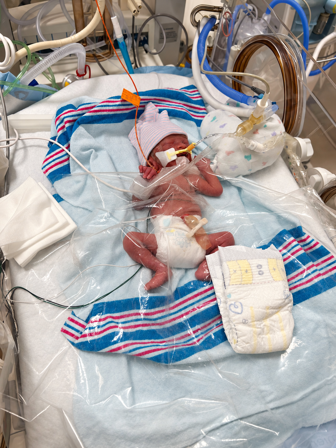 Baby Leandro receiving care in the NICU